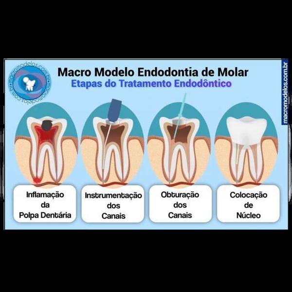 Imagem de Macro Modelo Anatômico Odontológico Endodontia De Molar