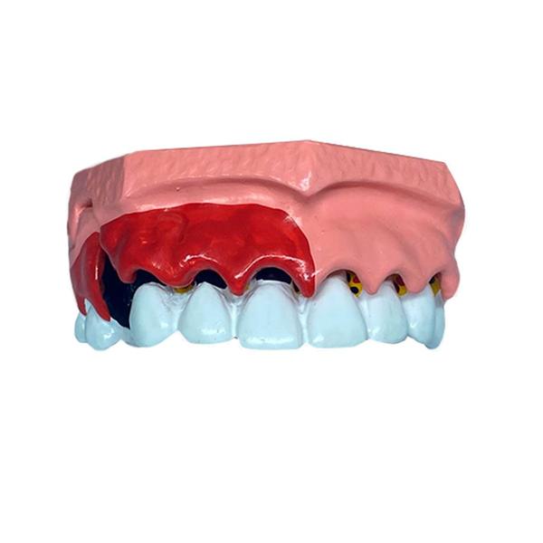 Imagem de Macro Modelo Evolução da Doença Periodontal