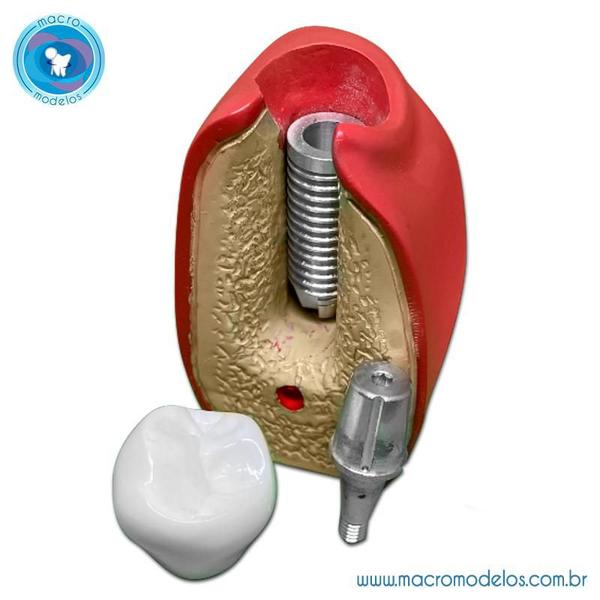 Imagem de Macro Modelo Implante Cone Morse