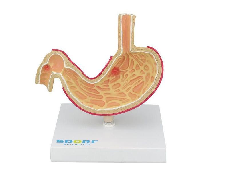 Imagem de Modelo Patológico Do Estômago