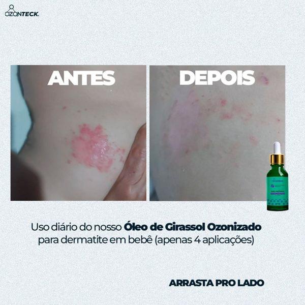 Imagem de Óleo de Girassol Ozonizado Ozonteck c/ Ácidos Graxos Essenciais, Ação Antioxidante Anti-Inflamatória