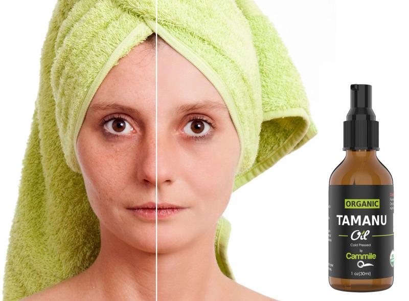 Imagem de Óleo de Tamanu Orgânico Cammile Q - Tratamento natural de Psoríase - Ótimo para Eczema, Acne & Cicatrizes - Pressionado a Frio