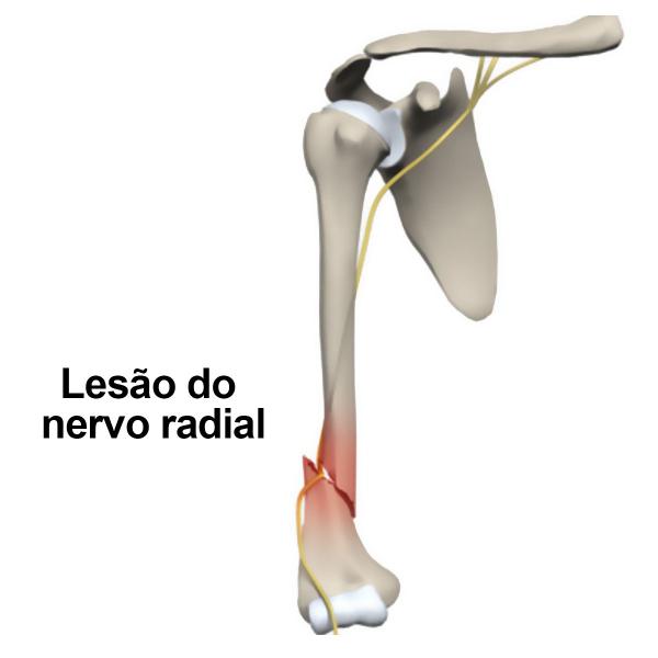 Imagem de Órtese Tutor Para Fratura de Úmero Sarmiento Todos Tamanhos Artipé