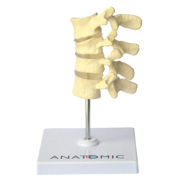 Osteoporose 4 Vértebras - Anatomic Imagem de Osteoporose 4 Vértebras