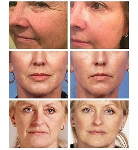 Imagem de Pomada Creme Removedor Clareado Melasma, Manchas Sardas