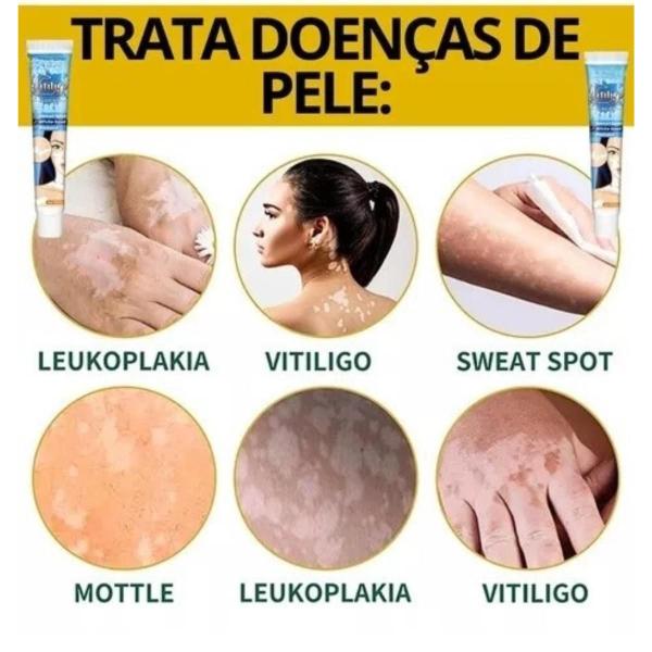 Imagem de Pomada Tratamento Vitiligo KanyeHB