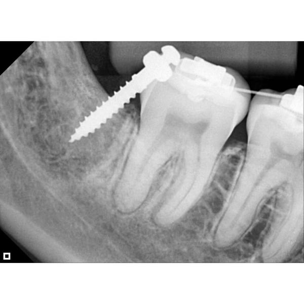 Imagem de Sensor Intraoral Digital Slim Tamanho 2 Saevo