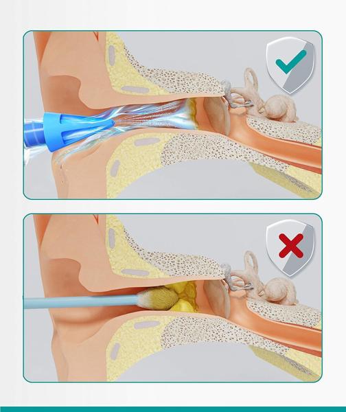 Imagem de Seringa de remoção de cera de ouvido Medi Grade Natural Clea