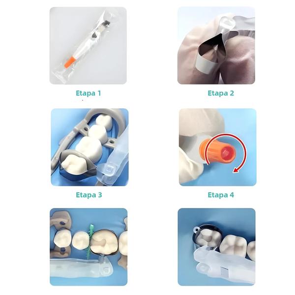 Imagem de Sistema de Anéis Seccionais para Matrizes Dentárias (4,5mm / 6,0mm) - Pré-formados