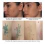 Imagem de Aparelho Caneta Laser Remove Mancha Tatuagem Profissional