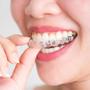 Imagem de Aparelho Ortodôntico de Silicone para Alinhamento Dentário - Retentor e Protetor Bucal