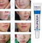 Imagem de BioAqua Creme para tratamento de acne e cicatrizes para remoção de cicatrizes