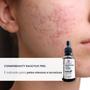 Imagem de Cosmobeauty Derma Peeling Salicylic Anti Acne 30g