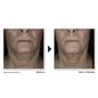 Imagem de Creme para Pescoço RoC Derm Correxion - Com Ácido Hialurônico e Retinol - 50mL