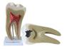 Imagem de Dente Molar Ampliado Saudável e Cárie  Modelo Anatomia