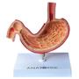 Imagem de Estômago Humano Com Patologias, Anatomia