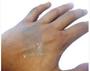 Imagem de Fita Cirúrgica De Silicone Adesiva Rolo 5cm x 1,5m  (Cicatriz e Queloide)- Vital Derme