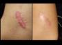 Imagem de Fita Cirúrgica De Silicone Adesivo Rolo 2,5cm x 1,5m  (Cicatriz e Queloide)- Vital Derme