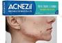 Imagem de Kit Acnezil Gel + Sabonete enxofre limpeza acne espinhas cravos