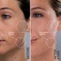 Imagem de Kit de Substituição para Dermaplanador Michael Todd SonicSmooth Pro+