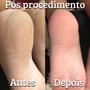 Imagem de Kit Spá dos Pés Calos e Calosidades Amolecedor Espátula