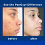 Imagem de Lavagem facial PanOxyl Acne Foaming Wash Peróxido de benzoíla 10% 163