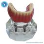 Imagem de Macro Modelo Mandíbula Overdenture Acrílica com 2 Barra Bola e Prótese Inferior