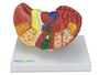Imagem de Modelo anatômico patológico do fígado e vesícula biliar sd5206