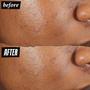 Imagem de Pimple Patch Kiehl's Truly Targeted Acne - 15ml com Ácido Salicílico