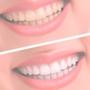 Imagem de Polidor Dental Portátil Azul Clareador Elétrico com 5 Astes Dentes Brancos Saudáveis