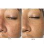 Imagem de Serum Facial Dermachem Melasma Clear Efeito Clareador