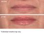 Imagem de Tratamento Labial NassifMD Hydro-Screen com Ácido Hialurônico