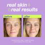 Imagem de Tratamento Local Dermalogica Clear Start - Pós-Acne